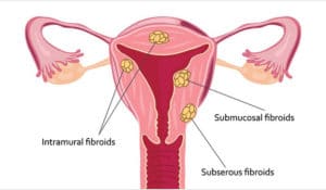 diagram-of-fibroids
