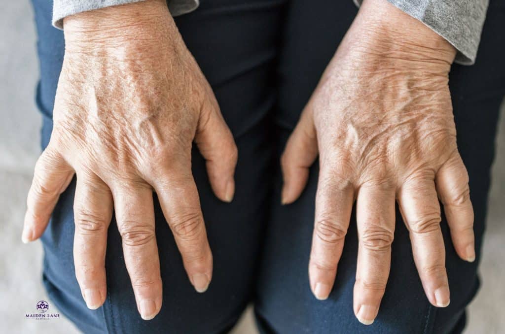 An older woman experiencing rheumatoid arthritis in her joints.