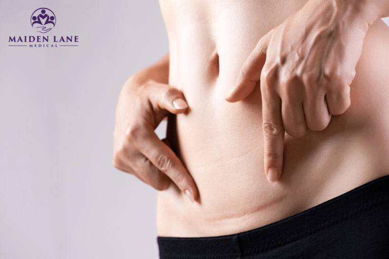 A woman with an abdominal scar from a c-section in Manhattan, New York.